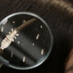 O imagine detaliată cu păduchi pe părul unei persoane, observată printr-o lupă.